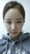 It's already been a year since I had the surgery~ — Korea cost, reviews & before-after | MISOODA