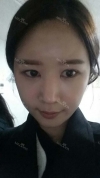 It's already been a year since I had the surgery~ — Korea cost, reviews & before-after | MISOODA