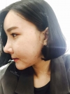 Ar + Zy + T + Pa (sil) + Rhino + weir + Ni (re) ptosis + Lat — Korea cost, reviews & before-after | MISOODA