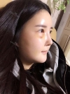 Ar + Zy + T + LP (jaw line) + thread lifting + (tack) Rhino (re) — Korea cost, reviews & before-after | MISOODA