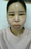 It's already been a year since I had the surgery~ — Korea cost, reviews & before-after | MISOODA