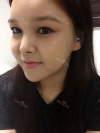 fg (forehead, zygoma), ni (fat), rhino (using donated cartilage and if more is needed ear cartilage) — Korea cost, reviews & before-after | MISOODA