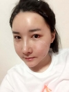 Ar + Zy + T + Pa (sil) + Rhino + weir + Ni (re) ptosis + Lat — Korea cost, reviews & before-after | MISOODA