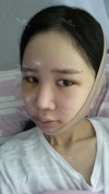 It's already been a year since I had the surgery~ — Korea cost, reviews & before-after | MISOODA