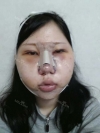 Ar + Zy (PPC) + T / adv + NI / ptosis + Rhino / lo #Free — Korea cost, reviews & before-after | MISOODA