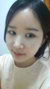 It's already been a year since I had the surgery~ — Korea cost, reviews & before-after | MISOODA