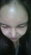 fg (forehead, zygoma), ni (fat), rhino (using donated cartilage and if more is needed ear cartilage) — Korea cost, reviews & before-after | MISOODA
