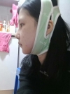 Ar + Zy (PPC) + T / adv + NI / ptosis + Rhino / lo #Free — Korea cost, reviews & before-after | MISOODA