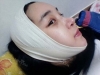 ar zy t (adv heading), fg (forehead), rhino (lo), pa (sil), aky ni (ptosis re), lat — Korea cost, reviews & before-after | MISOODA