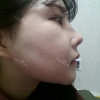 Ar + Zy (PPC) + T / adv + NI / ptosis + Rhino / lo #Free — Korea cost, reviews & before-after | MISOODA