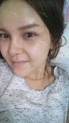 fg (forehead, zygoma), ni (fat), rhino (using donated cartilage and if more is needed ear cartilage) — Korea cost, reviews & before-after | MISOODA
