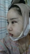 It's already been a year since I had the surgery~ — Korea cost, reviews & before-after | MISOODA