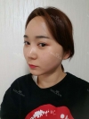 Ar + Zy + T / long hair + forehead / sil + epi + Rhino — Korea cost, reviews & before-after | MISOODA
