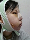 Ar + Zy (PPC) + T / adv + NI / ptosis + Rhino / lo #Free — Korea cost, reviews & before-after | MISOODA