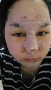 Ar + Zy + T / long hair + forehead / sil + epi + Rhino — Korea cost, reviews & before-after | MISOODA