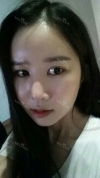 It's already been a year since I had the surgery~ — Korea cost, reviews & before-after | MISOODA