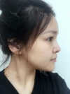 fg (forehead, zygoma), ni (fat), rhino (using donated cartilage and if more is needed ear cartilage) — Korea cost, reviews & before-after | MISOODA