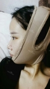 It's already been a year since I had the surgery~ — Korea cost, reviews & before-after | MISOODA