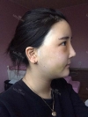 Ar + Zy + T + LP (jaw line) + thread lifting + (tack) Rhino (re) — Korea cost, reviews & before-after | MISOODA