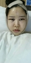 It's already been a year since I had the surgery~ — Korea cost, reviews & before-after | MISOODA