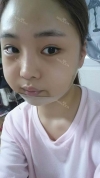 Ar + Zy + T / length extension — Korea cost, reviews & before-after | MISOODA