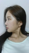 It's already been a year since I had the surgery~ — Korea cost, reviews & before-after | MISOODA