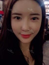 Ar + Zy + T + LP (jaw line) + thread lifting + (tack) Rhino (re) — Korea cost, reviews & before-after | MISOODA