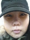 Ar + Zy (PPC) + T / adv + NI / ptosis + Rhino / lo #Free — Korea cost, reviews & before-after | MISOODA