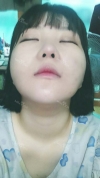 Ar + Zy (PPC) + T / adv + NI / ptosis + Rhino / lo #Free — Korea cost, reviews & before-after | MISOODA