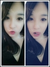 ar zy t (adv heading), fg (forehead), rhino (lo), pa (sil), aky ni (ptosis re), lat — Korea cost, reviews & before-after | MISOODA