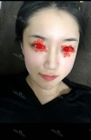 I did Thigh Liposuction and full face fat grafting, and nose filler injection. — Korea cost, reviews & before-after | MISOODA