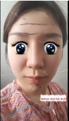 Forehead Fat Grafting & Botox — Korea cost, reviews & before-after | MISOODA