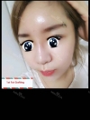 Forehead Fat Grafting & Botox — Korea cost, reviews & before-after | MISOODA