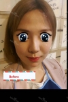 Forehead Fat Grafting & Botox — Korea cost, reviews & before-after | MISOODA