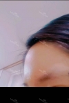 Full face fat graft  transferred fat from thigh — Korea cost, reviews & before-after | MISOODA
