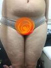 Thigh + Abdomen Liposuction — Korea cost, reviews & before-after | MISOODA