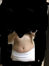 Abdomen Liposuction — Korea cost, reviews & before-after | MISOODA