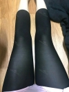 Thigh + Abdomen Liposuction — Korea cost, reviews & before-after | MISOODA