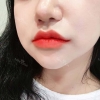 Lip Filler — Korea cost, reviews & before-after | MISOODA