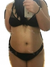 Whole Body Liposuction — Korea cost, reviews & before-after | MISOODA