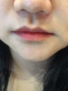 Lip Filler — Korea cost, reviews & before-after | MISOODA