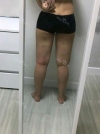 Thigh Liposuction — Korea cost, reviews & before-after | MISOODA
