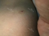 Finally did liposuction! — Korea cost, reviews & before-after | MISOODA