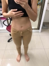 Finally did liposuction! — Korea cost, reviews & before-after | MISOODA