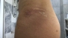 Finally did liposuction! — Korea cost, reviews & before-after | MISOODA