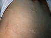 Finally did liposuction! — Korea cost, reviews & before-after | MISOODA
