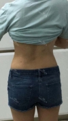 Finally did liposuction! — Korea cost, reviews & before-after | MISOODA