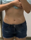 Finally did liposuction! — Korea cost, reviews & before-after | MISOODA