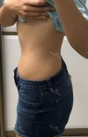 Finally did liposuction! — Korea cost, reviews & before-after | MISOODA