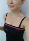 Accu & thread lift — Korea cost, reviews & before-after | MISOODA